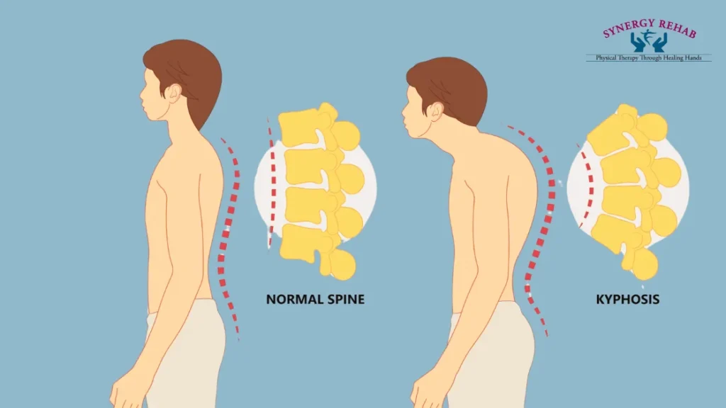 Kyphosis Diagnosed - Normal Spine and kyphosis