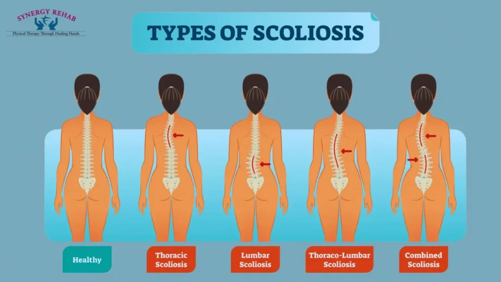 Types of Scoliosis