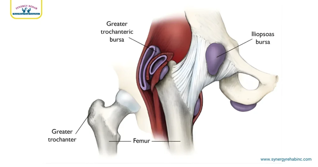 Gluteal Tendinopathy