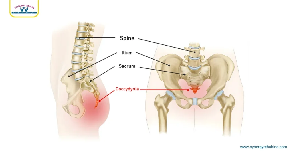 What is Postpartum Coccydynia (Tailbone Pain)